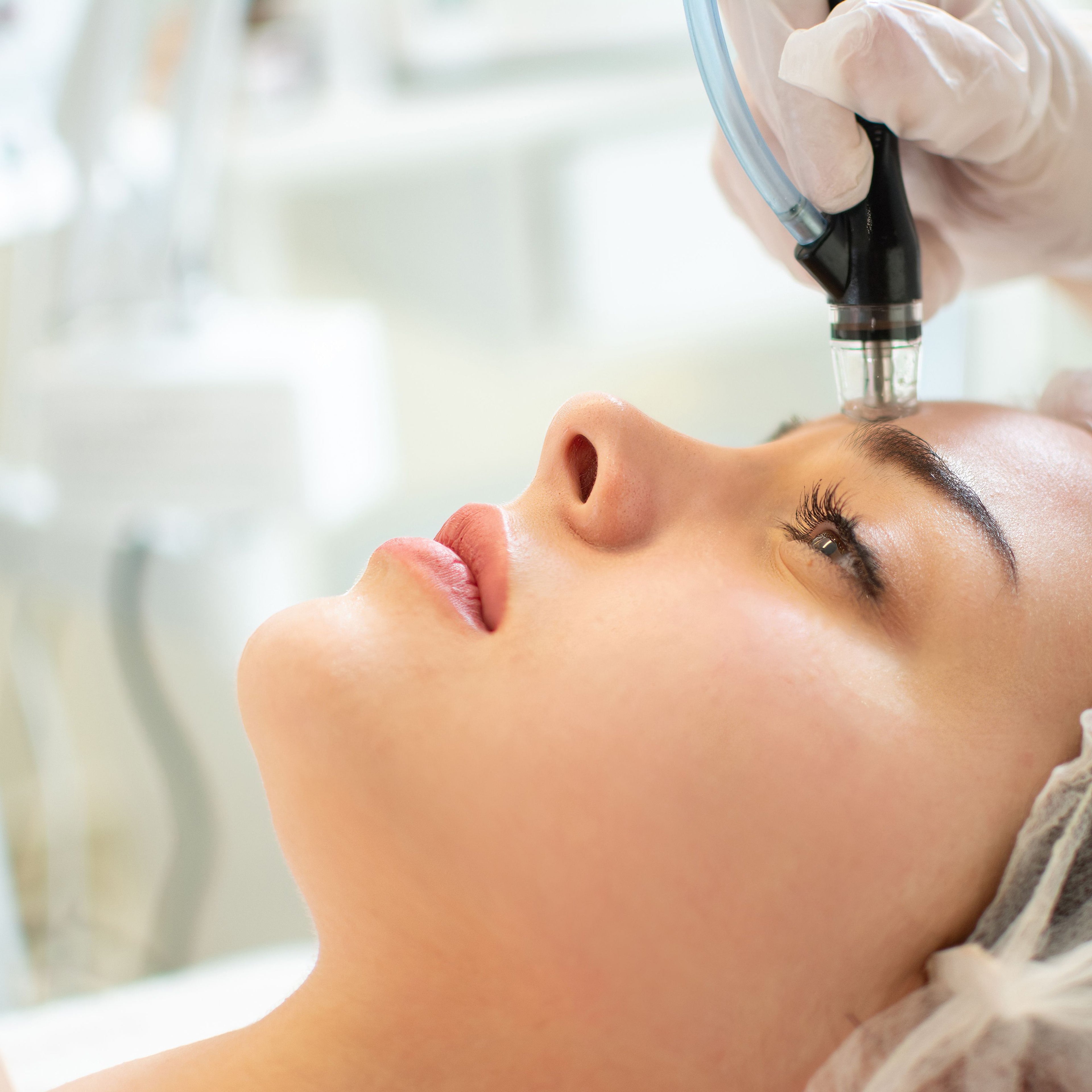 Needling Viso